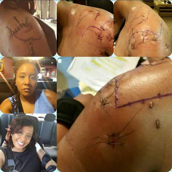 Black Female Police Brutality Survivor needs 3rd Surgery Cleveland Black Lives Matter
